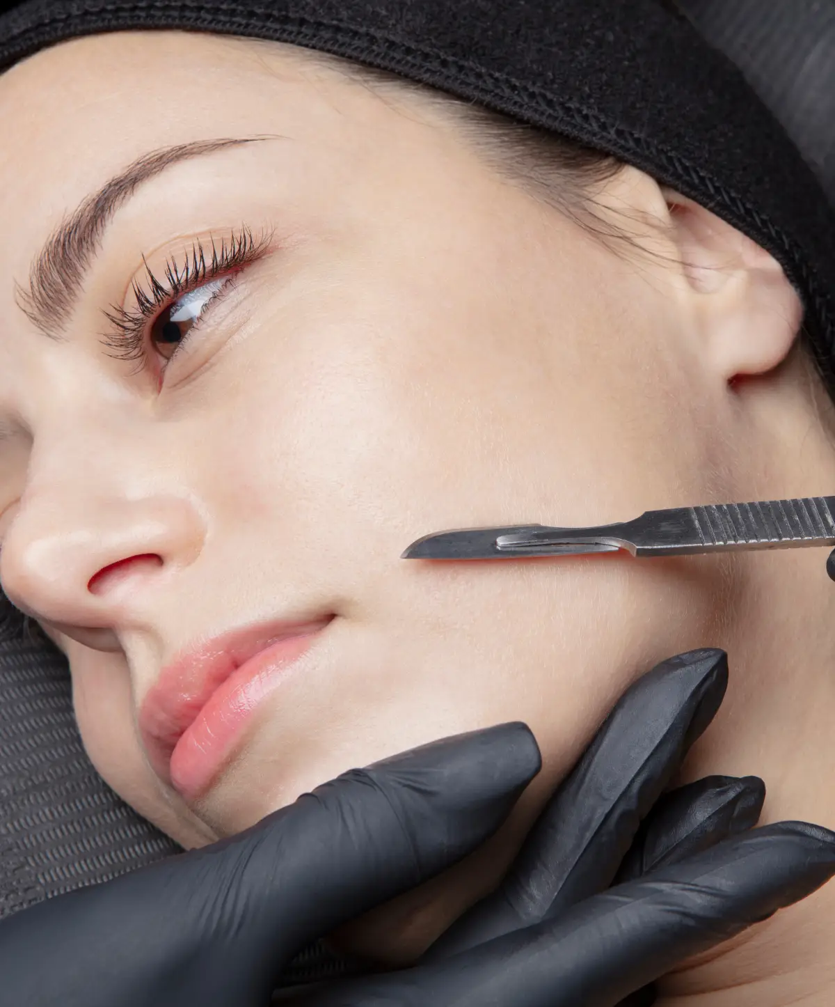 Dermaplaning treatment being performed on facial skin