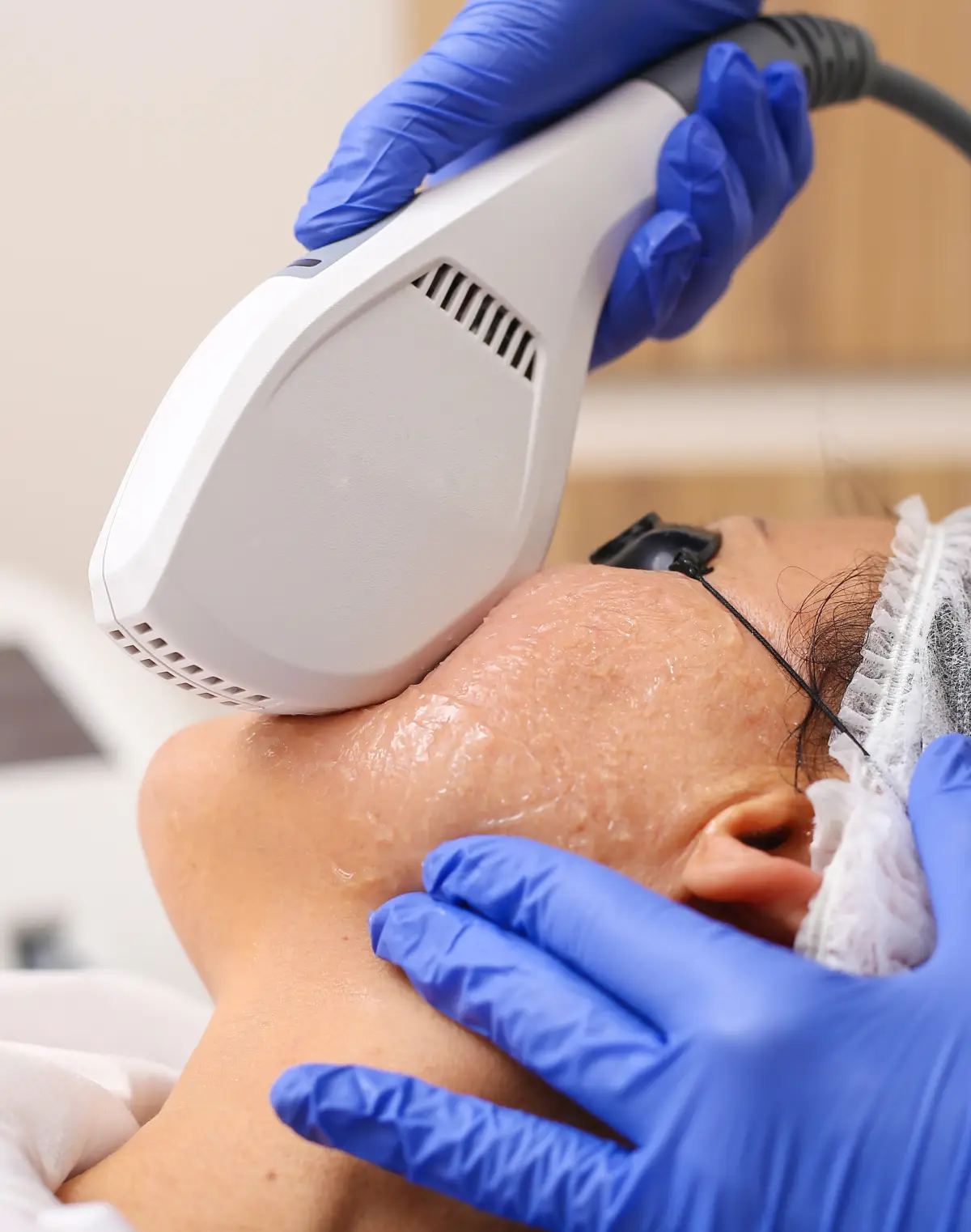 IPL photofacial treatment being performed on a client's skin