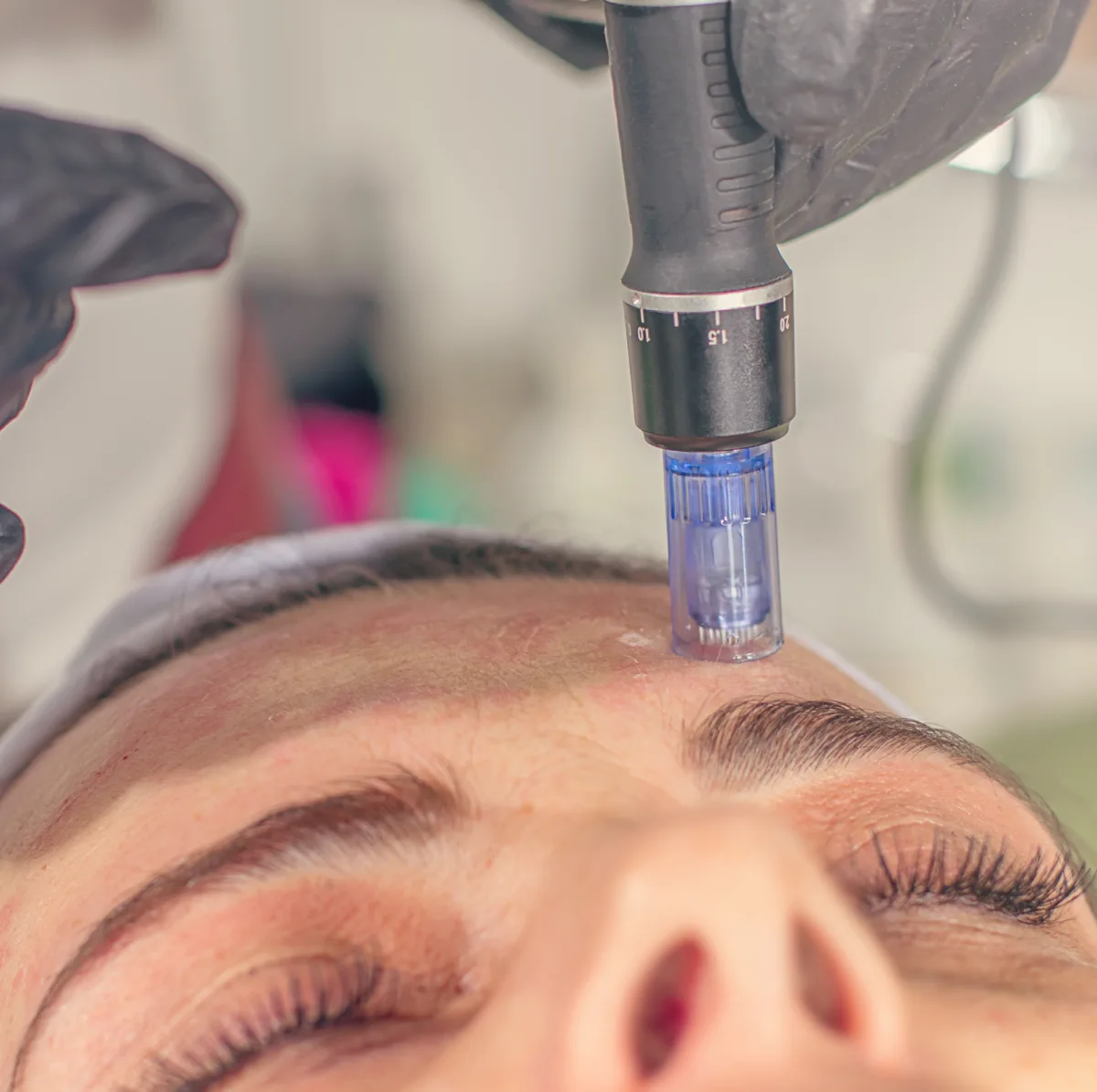 Professional microneedling procedure for smoother skin texture