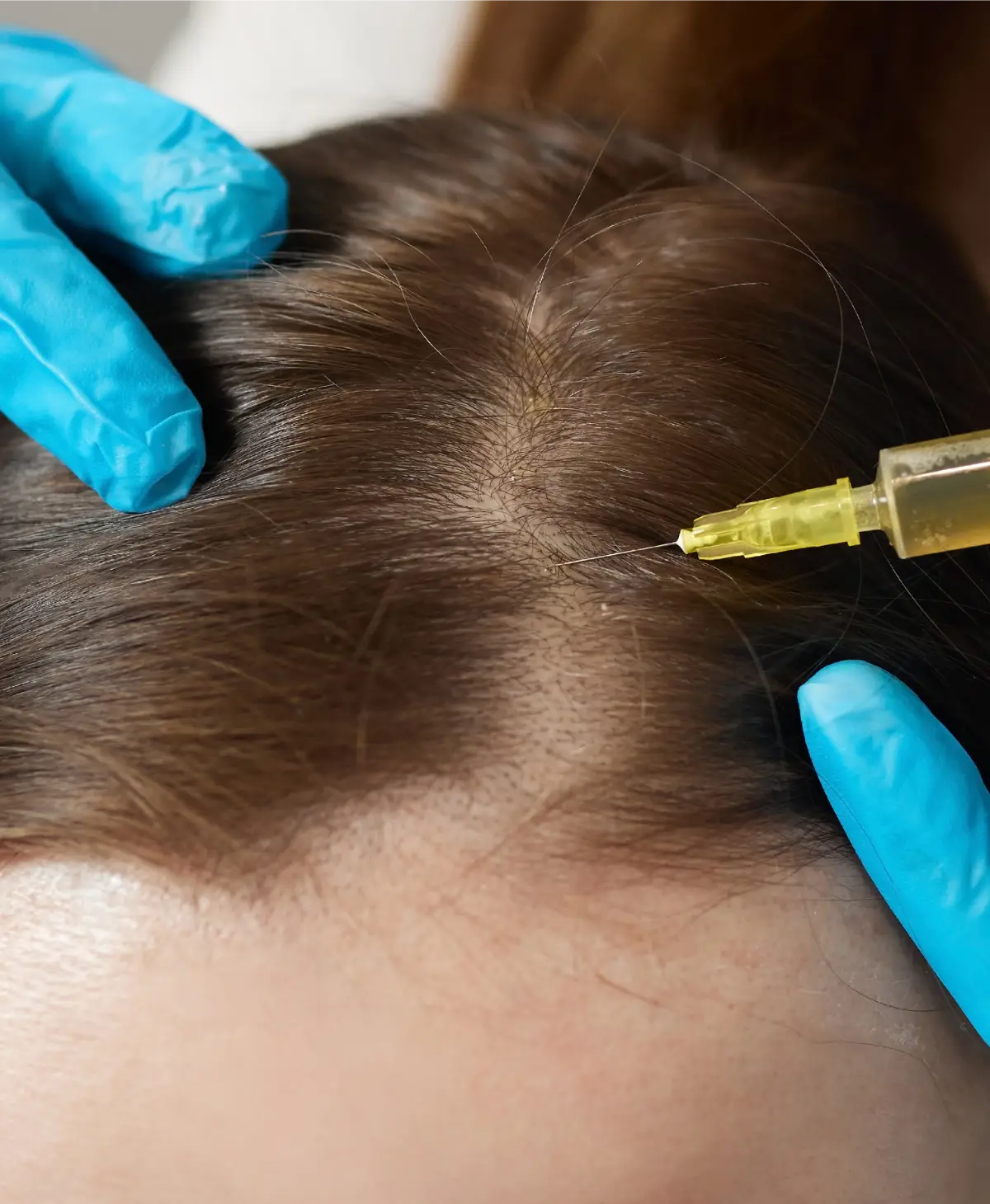 PRP hair restoration treatment for thinning hair and hair loss