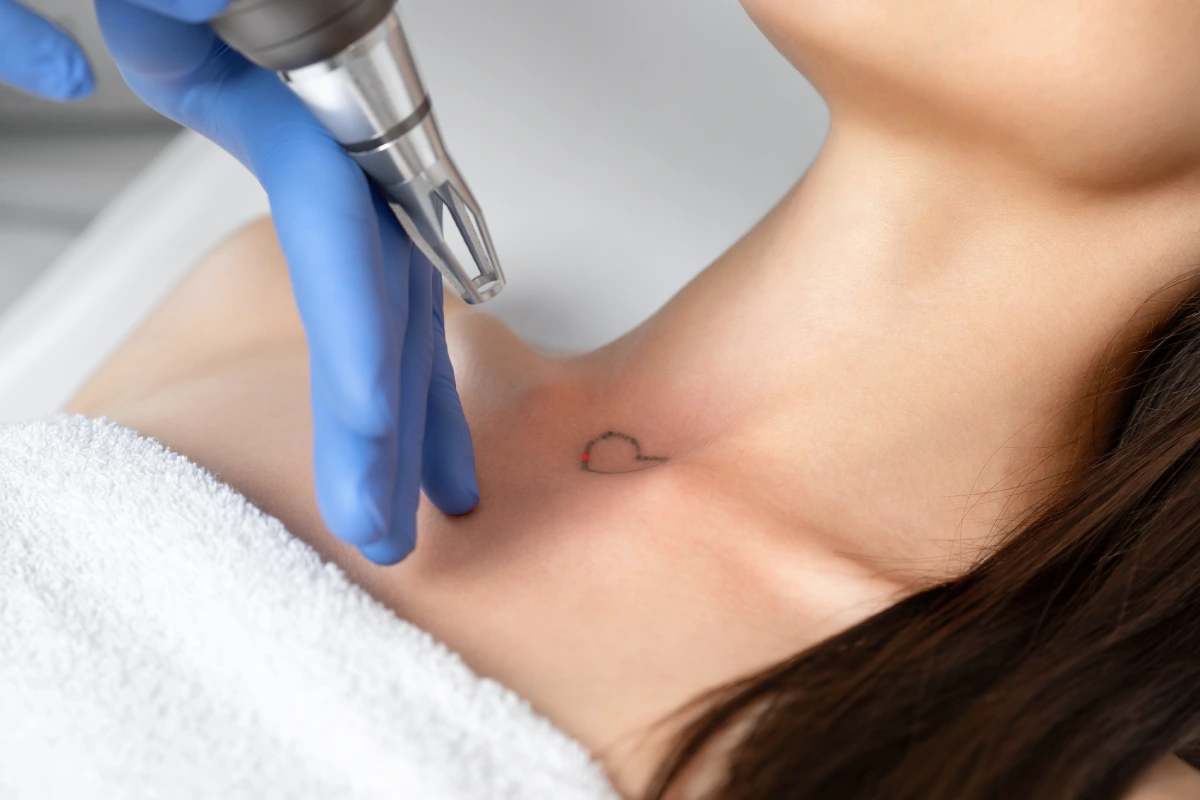 Laser tattoo removal treatment using advanced laser technology