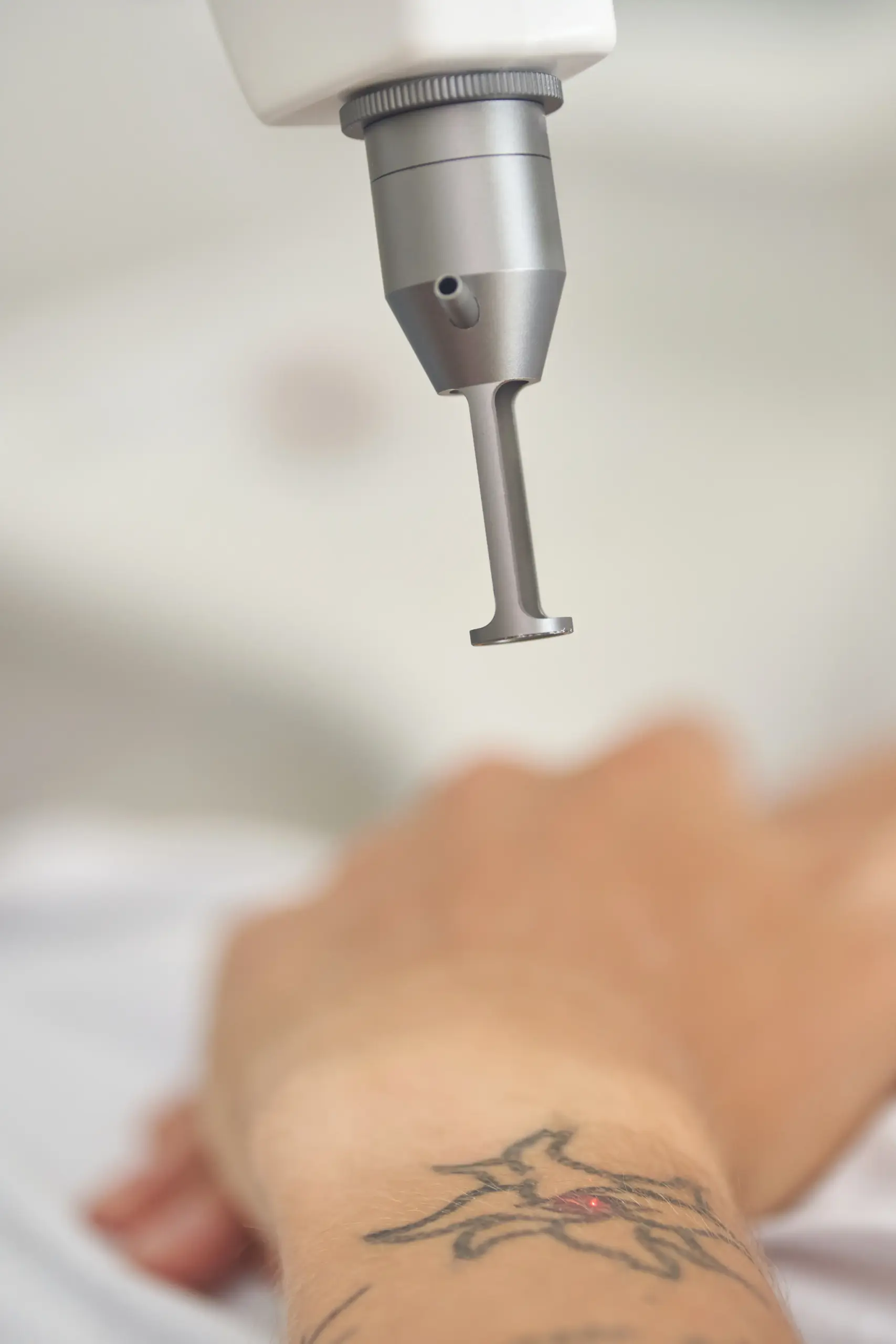 Laser tattoo removal treatment device in action